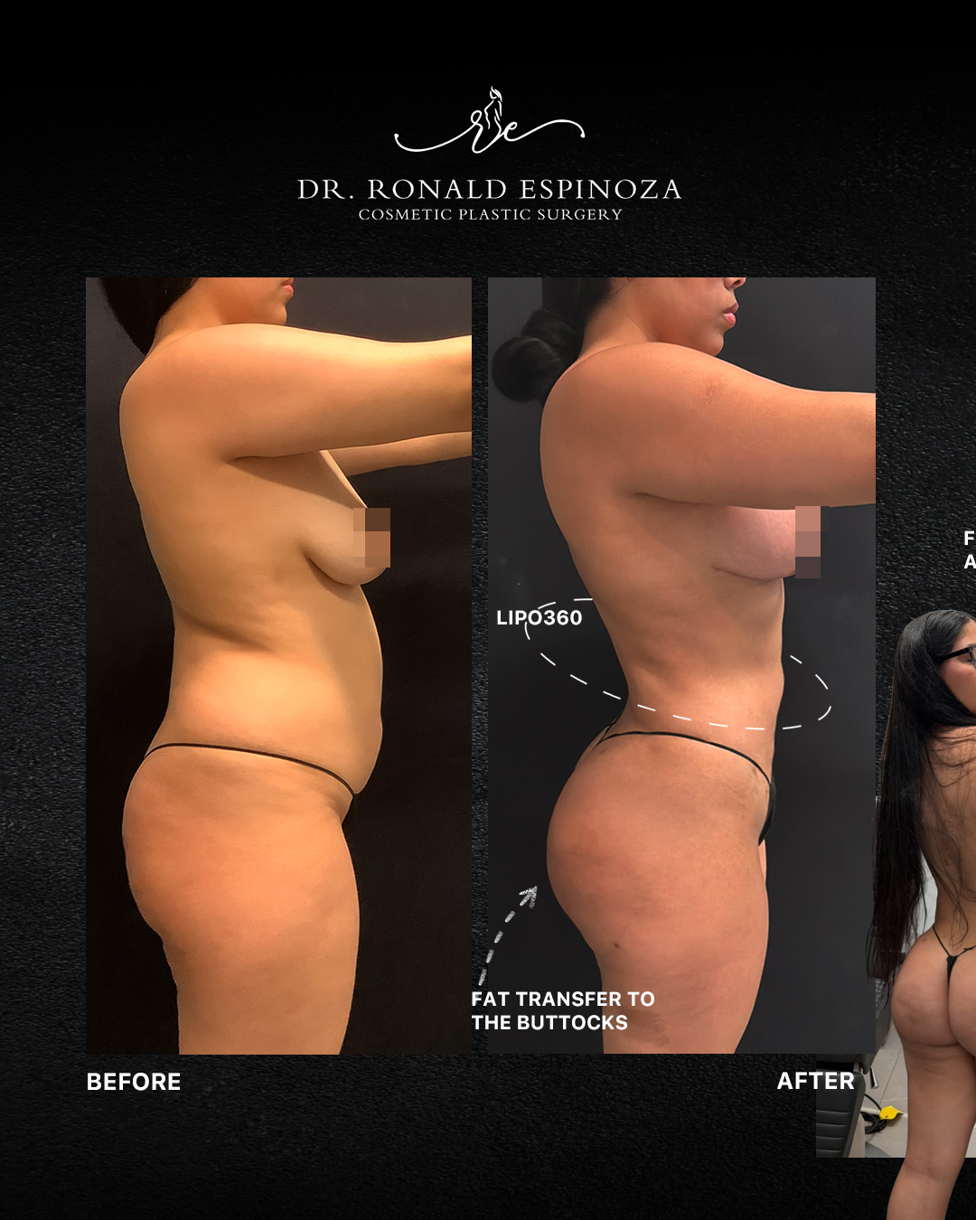 BBL New York: Preparación Crucial en las Dos Semanas Previas a Su Cirugía — Dr. Ronald Espinoza, board-certified plastic surgeon