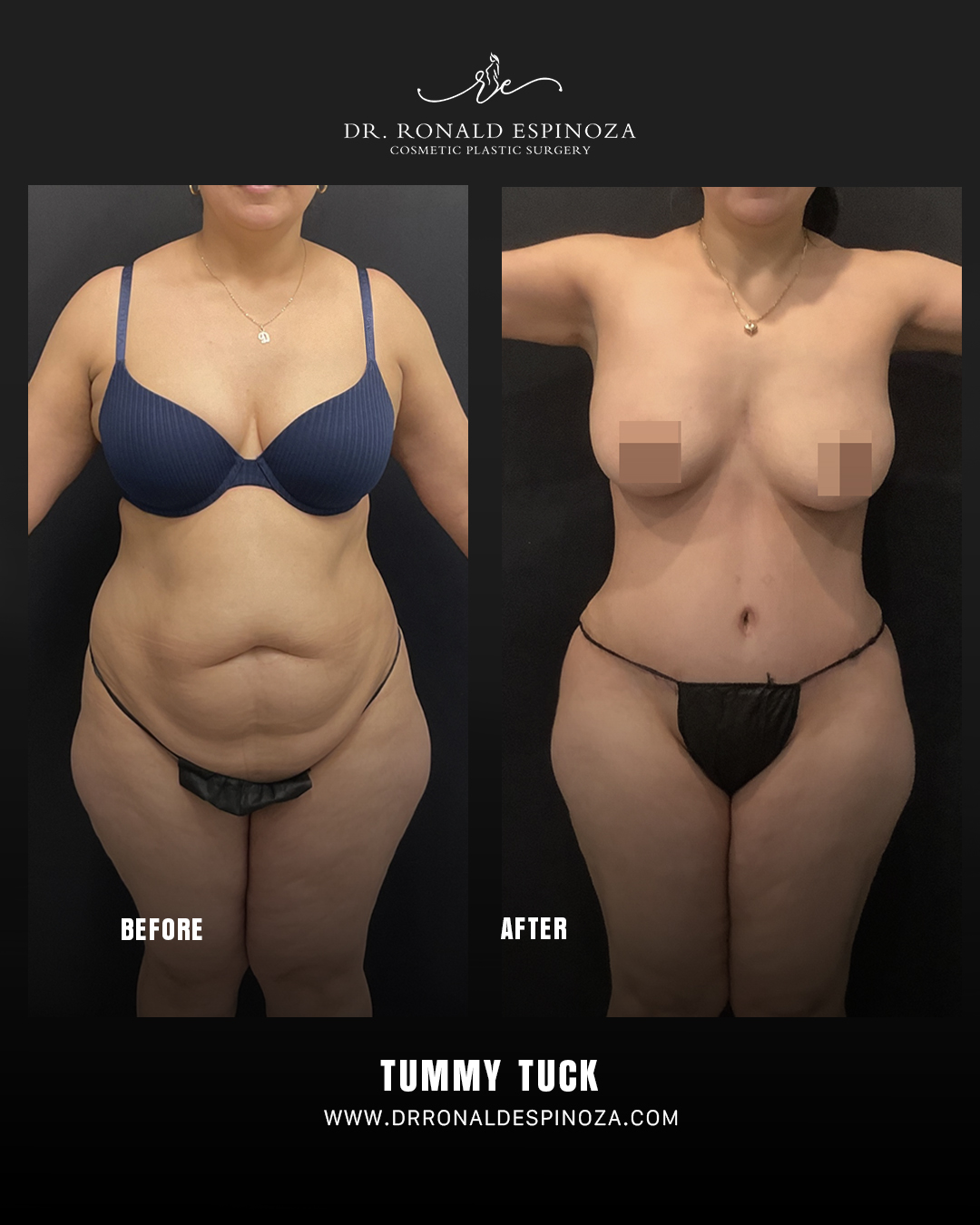 Navigating Your Mommy Makeover Recovery in New York — Dr. Ronald Espinoza, board-certified plastic surgeon