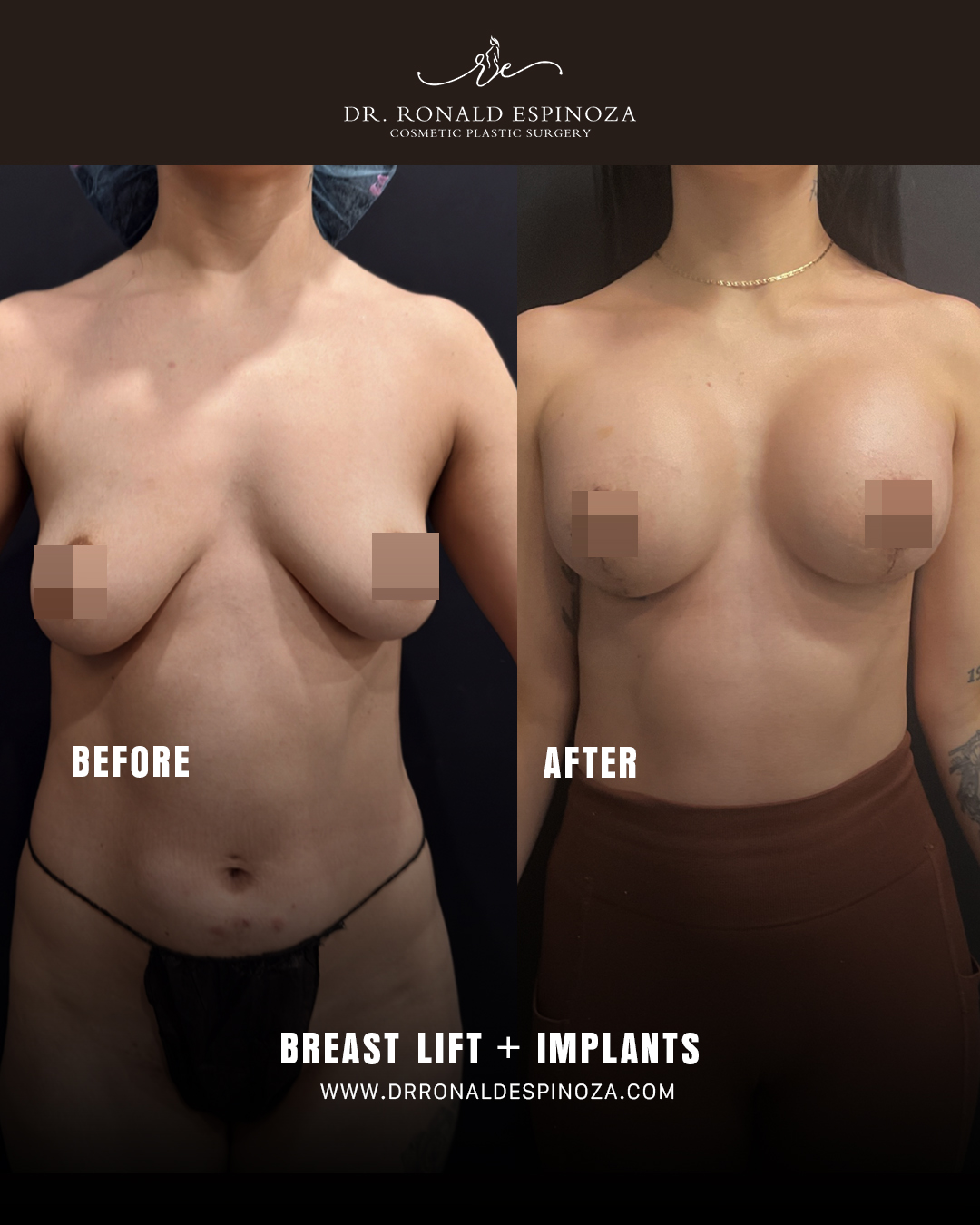 Breast Augmentation with Lift in New York: Restoring Contour and Confidence — Dr. Ronald Espinoza, board-certified plastic surgeon