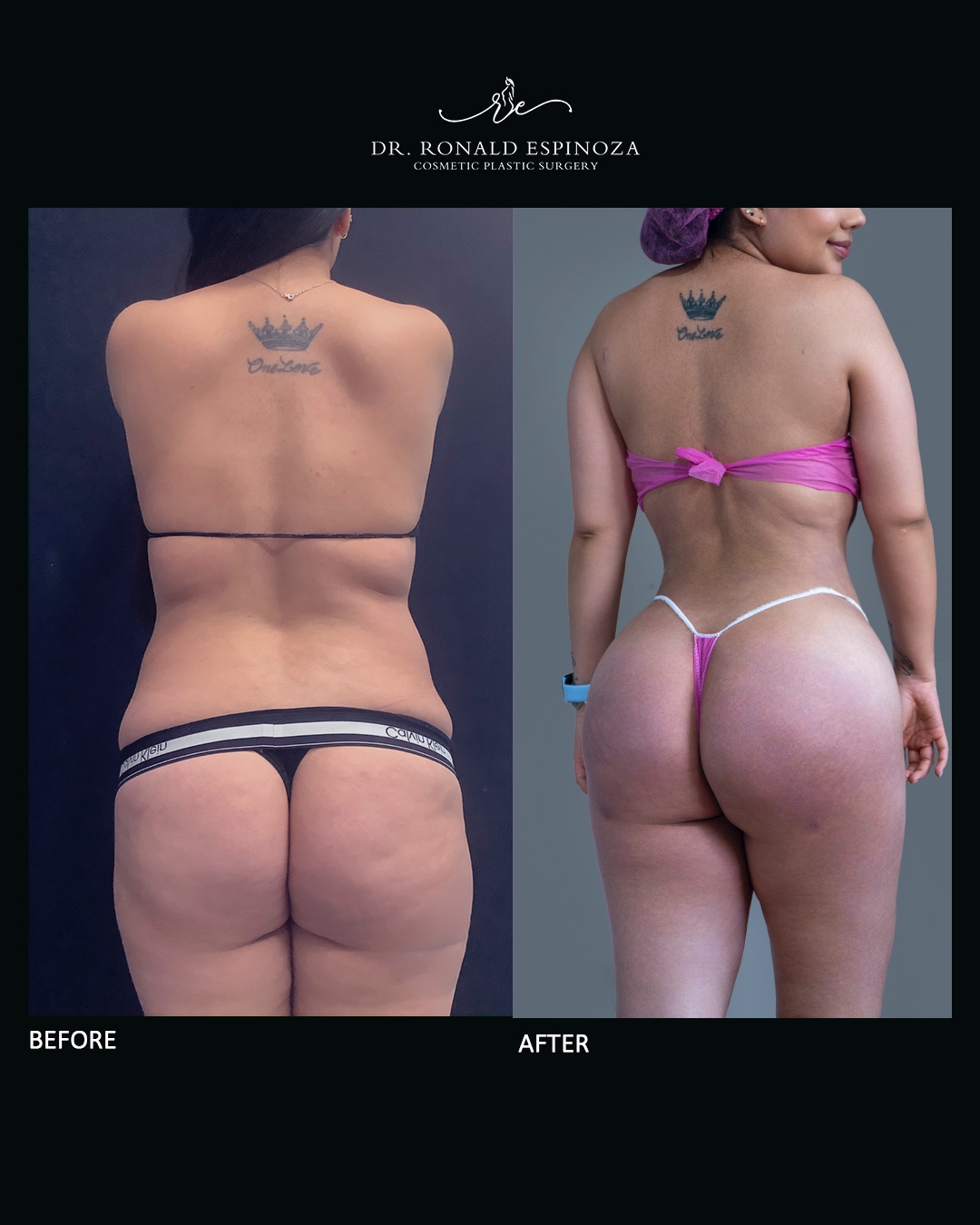 Candidatas ideales para Lipo + BBL en New York: ¿Eres apta para esta cirugía? — Dr. Ronald Espinoza, board-certified plastic surgeon