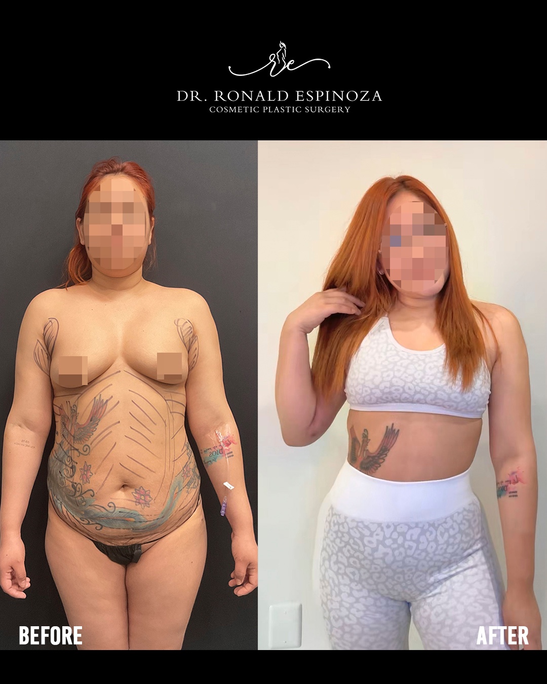 Lipo + BBL en New York: Cómo Entender los Costos y Qué Incluye un Presupuesto Médico — Dr. Ronald Espinoza, board-certified plastic surgeon
