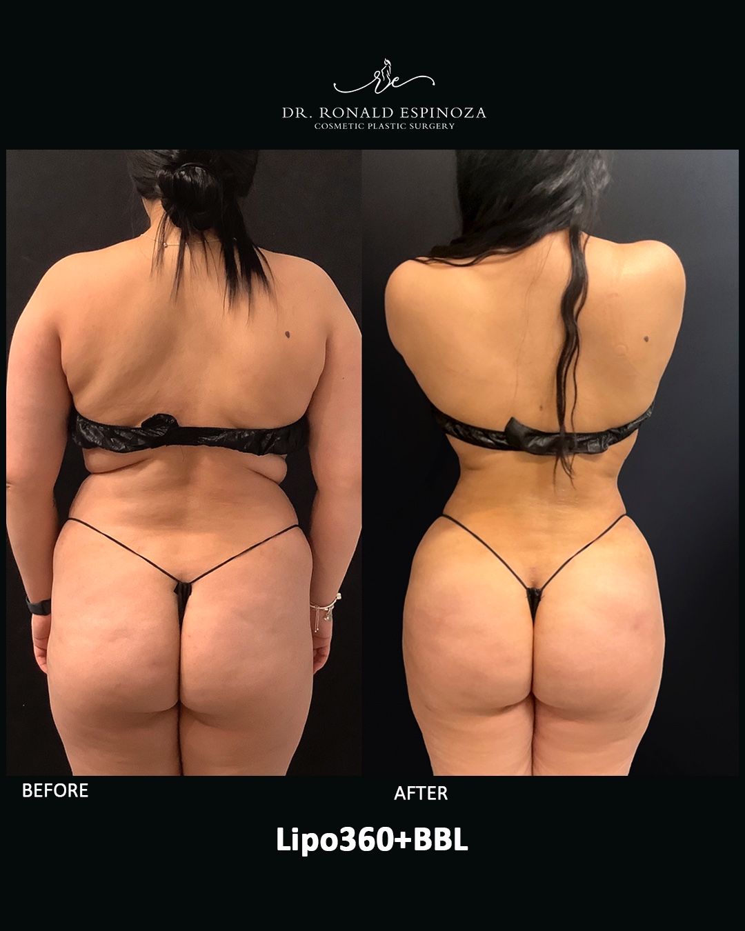 ¿Cómo mantener los resultados de tu Lipo + BBL a largo plazo en New York? — Dr. Ronald Espinoza, board-certified plastic surgeon