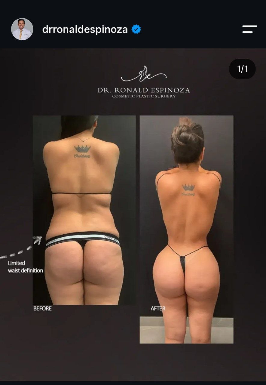 BBL en New York: Qué es el levantamiento de glúteos brasileño y cómo se realiza paso a paso — Dr. Ronald Espinoza, board-certified plastic surgeon